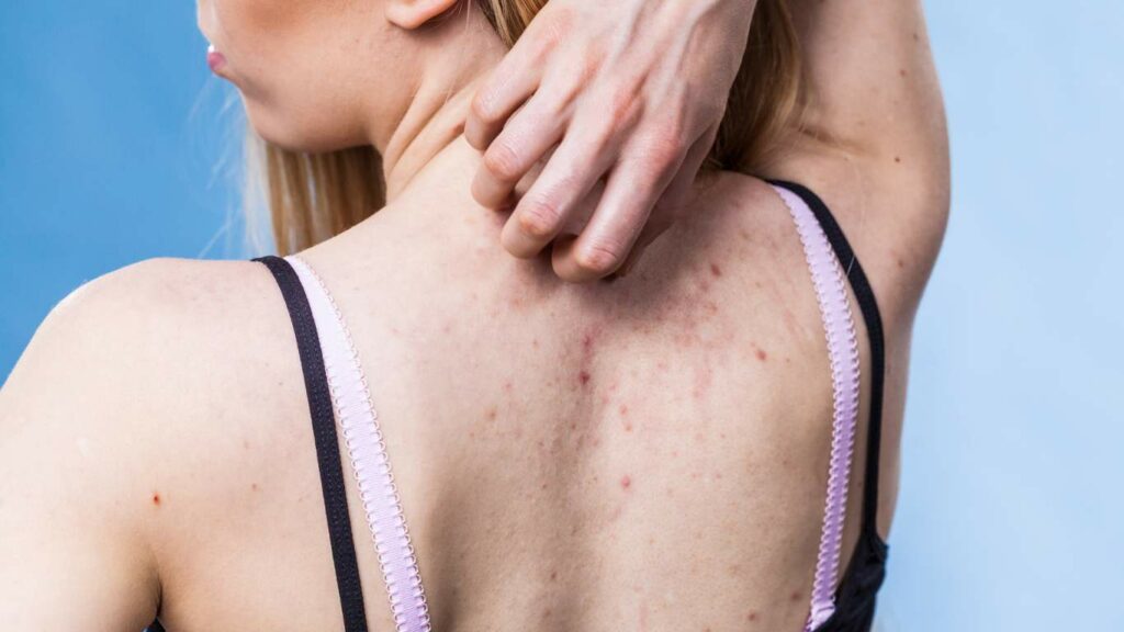 Acne inversa melocare gmbh 1