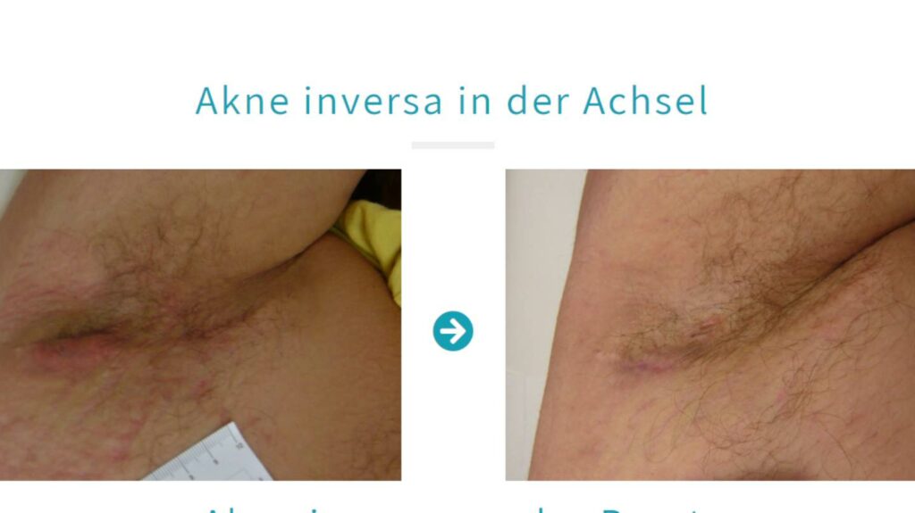 Pickel in der Achselhoehle Was sie bedeuten und was Sie tun koennen