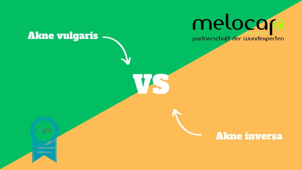 Unterschiede zwischen Akne vulgaris und Akne inversa