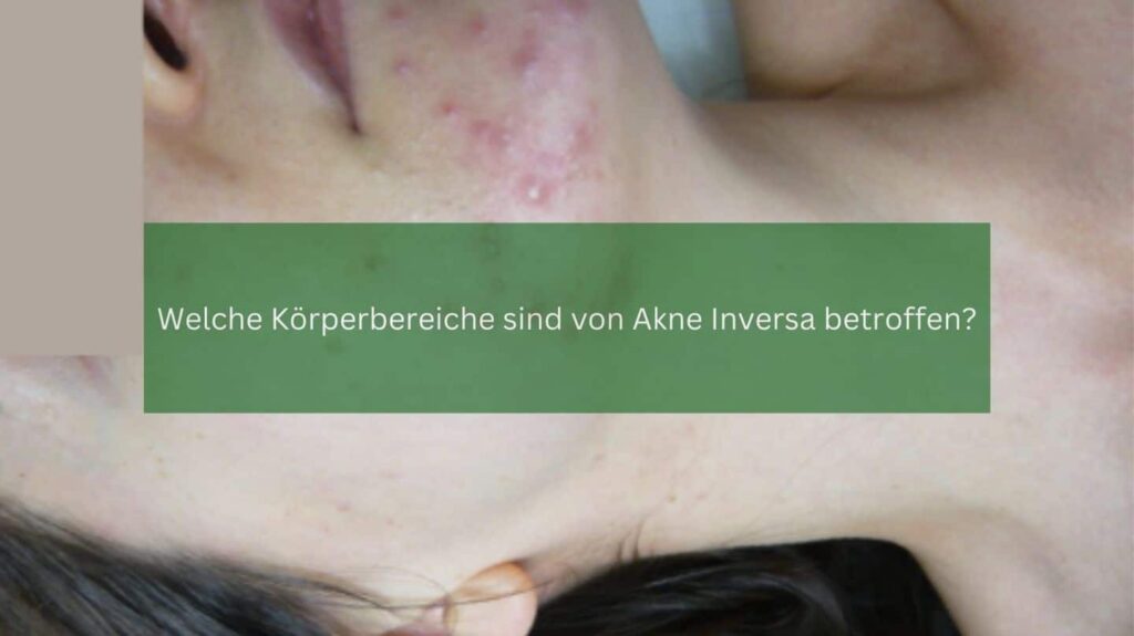 Welche Koerperbereiche sind von Akne Inversa betroffen